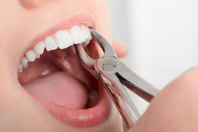 کشیدن دندان از نتایج بالا رفتن تعرفه های دندانپزشکی در خراسان شمالی